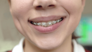 braces