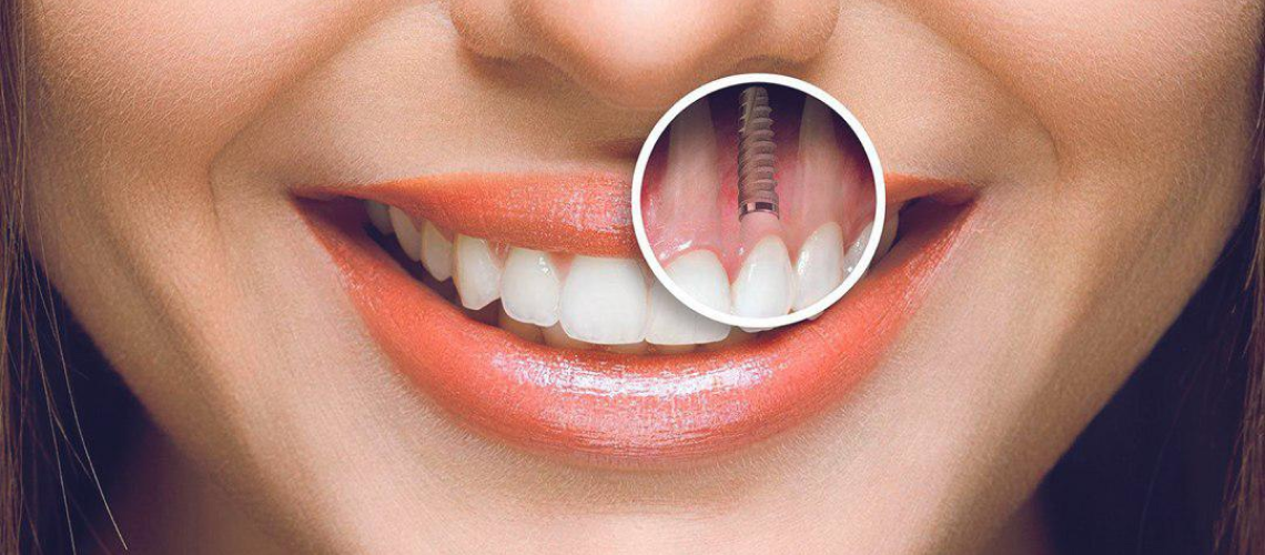 implant